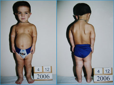 Achondroplasia Dwarfism Treatment